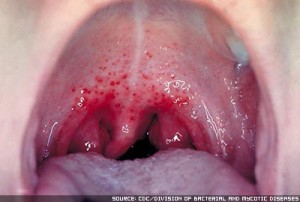 Лечение ангины у маленьких детей